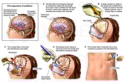 Decompressive Craniectomy and Ventriculostomy
