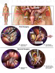 Procedures to Remove Adhesions and the Left Fallopian Tube