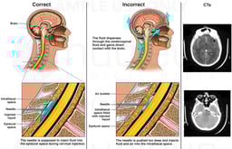Incorrect Cervical Injection with Resulting Complications