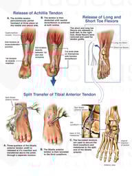Various Surgical Procedures for Varus Equinus Deformity