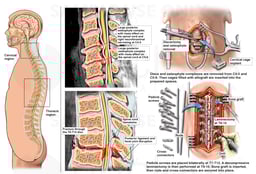 Cervical and Thoracic Spine Injuries with Spinal Cord Damage