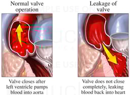 Aortic Valve Bloodflow