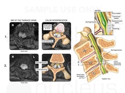 Post Trauma Spinal Cord Syrinx