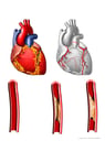 Anatomy of the Heart with Potential Blockage Sites in Coronary Arteries