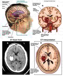 Cerebral Hemorrhage Secondary to Administration of Tissue Plasminogen Activator (TPA)