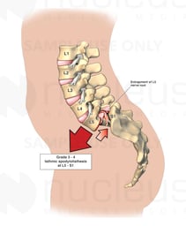 Lumbar Spine Injury