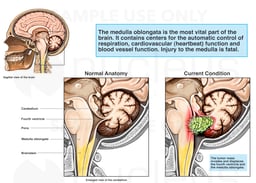 Invasive Tumor of the Brainstem