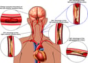 Upper Torso, Heart and Brain with Severe Arterial Blockages