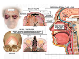 Head Trauma - MVA