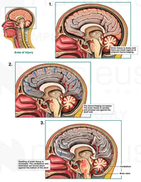 Progression of Anoxic Brain Damage