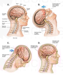 Whiplash - Front to Back Closed Head Injury