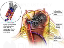 Spinal Cord Infarct- Stroke