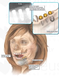 Inferior Alveolar Nerve Injury