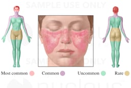 Lupus Erythematosus