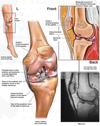 Left Knee Injuries
