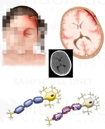 Scalp Laceration and Brain Injury with Damage to the Axons