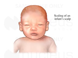 Cradle Cap
