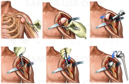 Total Shoulder Arthroplasty with Joint Replacement