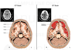 Subdural Hematoma - Intracranial Bleed