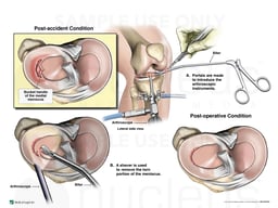 Right Lateral Bucket Handle Meniscal Tear with Arthroscopic Repair