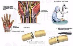 Microsurgical Repair of a Median Nerve Transection