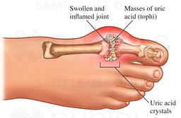Gout of the Big Toe