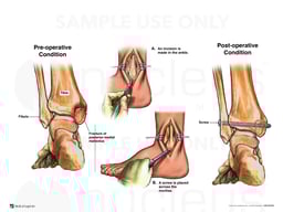 Left Ankle Fracture Dislocation with Surgical Fixation