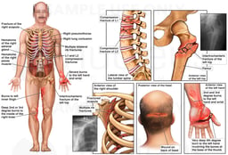 Male Figure with Spine, Hip, Shoulder, Scalp and Hand Injuries