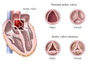 Aortic Valve, open and closed, healthy and stenosed