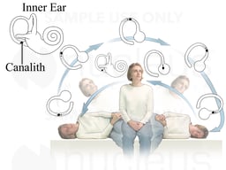 Semount: Vertigo Treatment
