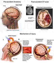 Traumatic Closed Head Injury