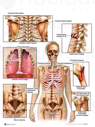 Widespread Traumatic Injuries
