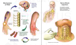 Post-surgical Reflex Sympathetic Dystrophy (RSD) of the Upper Extremity and Hand with Nerve Block Injection