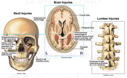 Post-accident Injuries to the Skull, Brain, and Lumbar Spine