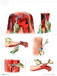 Surgical Debridement and Skin Grafting