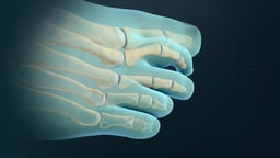 Hammertoe and Claw Toe Correction