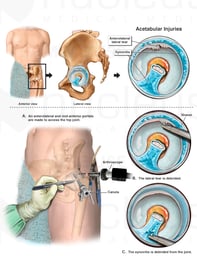 Left Hip Arthroscopy