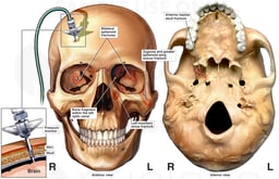 Post-accident Skull Fractures and Placement of Intracranial Pressure Monitor (ICP)