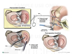 Right Medial Bucket Handle Meniscal Tear with Arthroscopic Repair