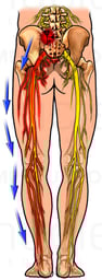 Sciatic Nerve Pain - Sciatica