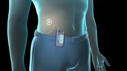 Insulin Pump