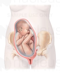 Fetus in Right Sacrotransverse Position in a Bicornuate Uterus