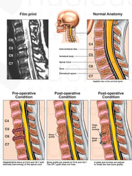 Traumatic Injury to the Cervical Spine with Surgical Repair