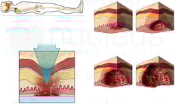 Formation of a Pressure Sore (Bedsore or Decubitus Ulcer)
