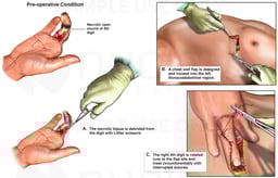 Debridement and Thoracoabdominal Flap Coverage of the Fourth Finger