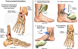 Trimalleolar Ankle Fractures (Broken Ankle) with Surgical Fixation