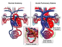Normal Heart Anatomy vs. Heart Anatomy with Acute Pulmonary Edema