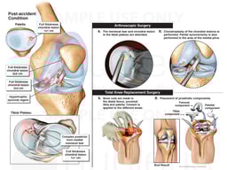 Left Knee Injuries and Surgeries