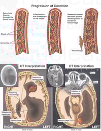 Cerebral Arteritis with Intraventricular Hemorrhage