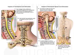 Spinal Cord Stimulator to Treat Continued Cervical Pain